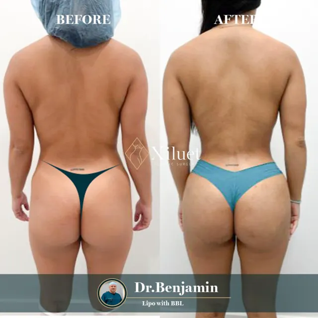 Lipo with BBL · Dr. Benjamin Liliav