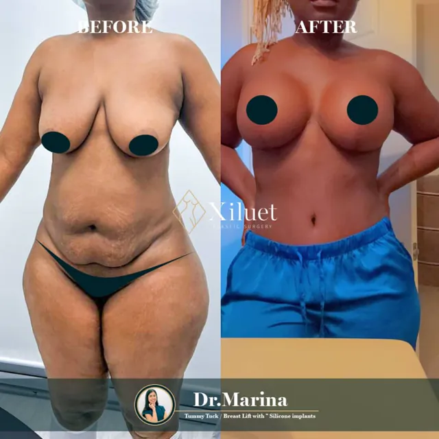 Tummy tuck + breast lift + silicone implants · Dr. Marina Zorrilla